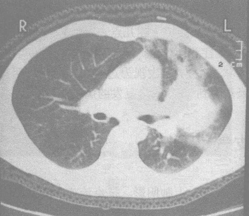 病例3 非典型支气管类癌